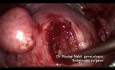 Outpatient Polymyomectomy
