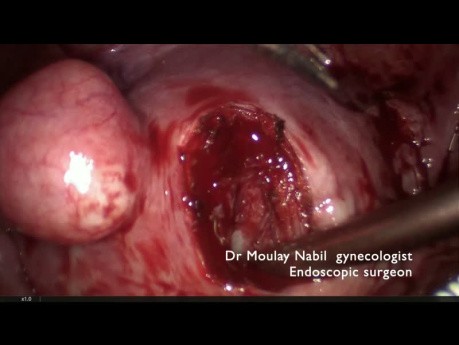 Outpatient Polymyomectomy