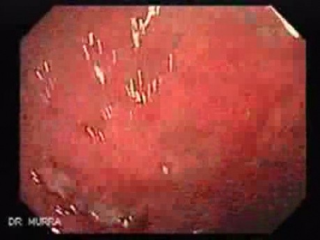 Multiple Rectal Ulcers (3 of 110)