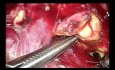 Spleen Preserving Distal Pancreatectomy in Traumatic Grade 3 Pancreatic Injury