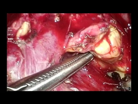 Spleen Preserving Distal Pancreatectomy in Traumatic Grade 3 Pancreatic Injury