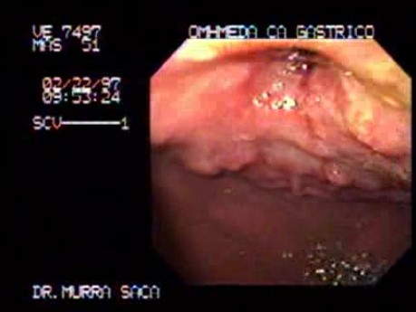 Pre - Pyloric Gastric Carcinoma - Endoscopy (1 of 2)