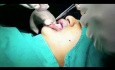 Upper and Lower Lip Reduction Surgery
