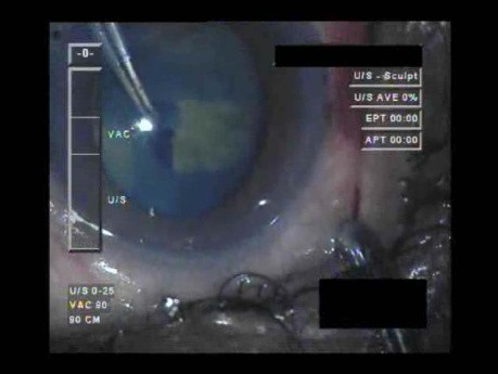 Cataract Surgery