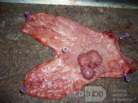 Polypoid Adenocarcinoma (2 of 9)