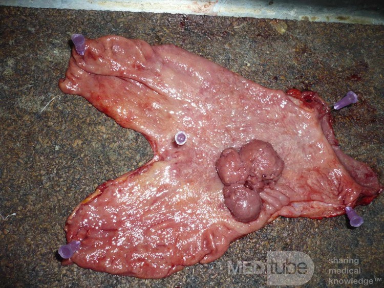 Polypoid Adenocarcinoma (2 of 9)
