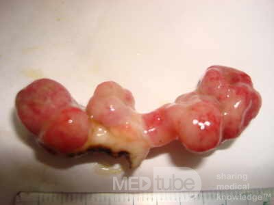Colonoscopic Polypectomy (20 of 29)