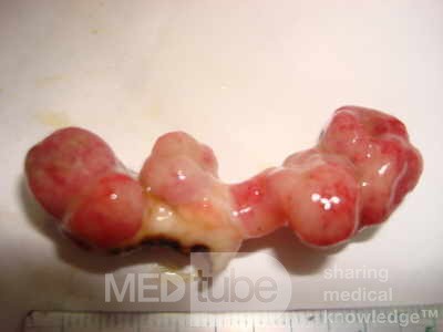 Colonoscopic Polypectomy (20 of 29)