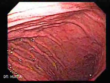 Acute Gastritis (3 of 6)