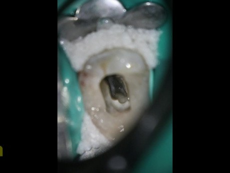 Mandibular premolar with 3 canals