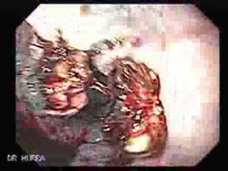 Hemorrhage After Ligation - Status Post Therapy