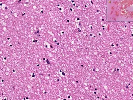 Hemorrhage - Histopathology of brain