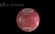 Endoscopic Grommet for Glue Ear and Guidelines 