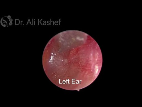 Endoscopic Grommet for Glue Ear and Guidelines 