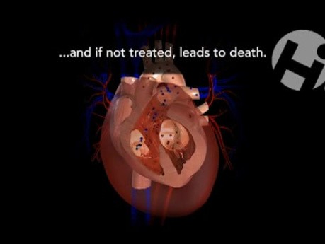 Ventricular Rupture