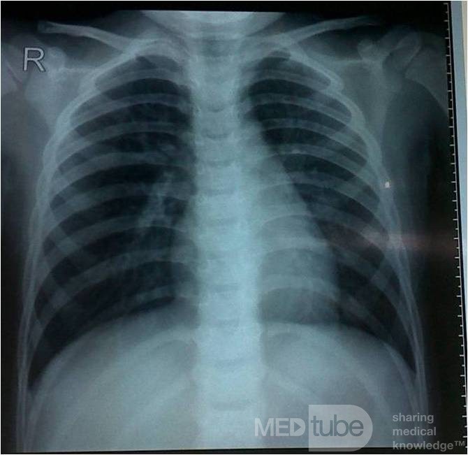 Bronchopneumonia