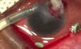 Use of Anterior Chamber Member Maintainer in Case of Endophthalmitis