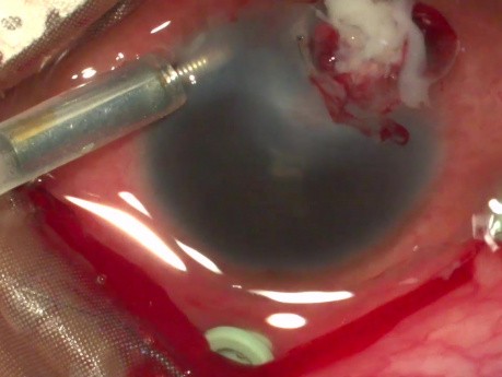Use of Anterior Chamber Member Maintainer in Case of Endophthalmitis