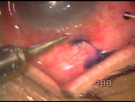 Absolute Glaucoma & Non-healing Corneal Ulcer - TCF