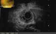 EUS resection of duodenal polyps
