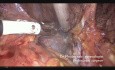 Nerve Sparing C1 Radical Hysterectomy for Cervical Cancer