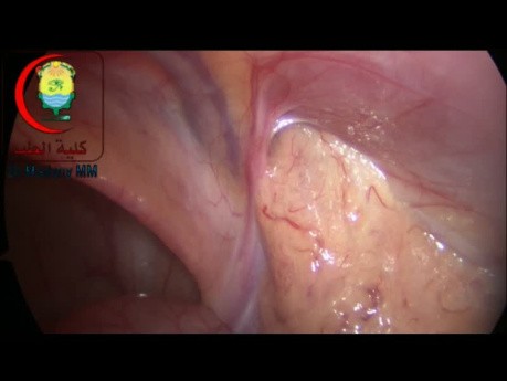 Proper Positioning of the Patient is Essential in Laparoscopic Surgery