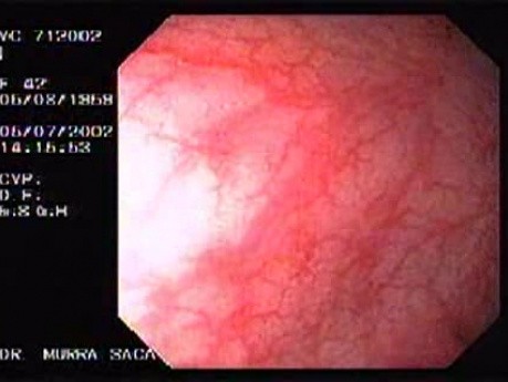 Crohn's Disease - Endoscopy (9 of 28)