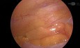 Taxis in Laparoscopic Inguinal Hernia Surgery
