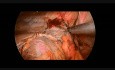 Laparoscopic Repair of Left-sided Diaphragmatic Hernia in 12-year Old Boy