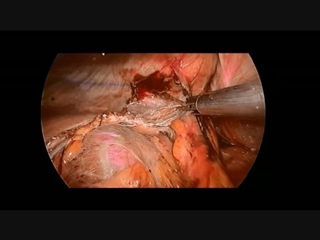 Laparoscopic Repair of Left-sided Diaphragmatic Hernia in 12-year Old Boy