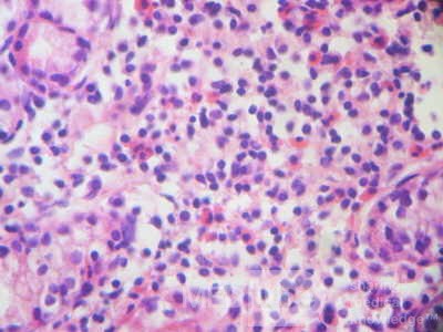 Eosinophilic Gastritis (4 of 7)