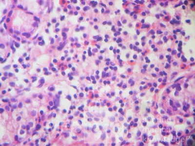Eosinophilic Gastritis (4 of 7)