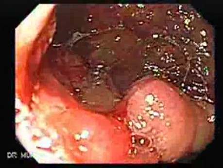 Cholangiocarcinoma (2 of 4)