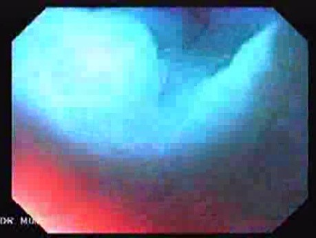 Gastric Folds - Magnification (4 of 8)