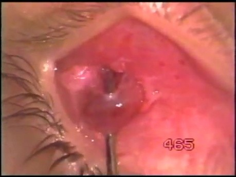 Inferior Oblique Myomectomy - Fugo Blade