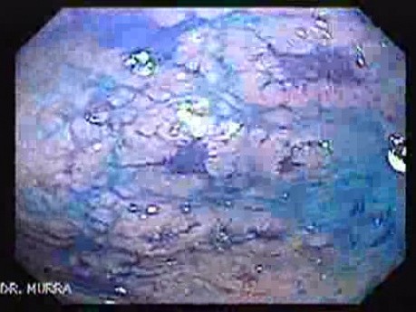 Pre - Pyloric Ulcer - Endoscopy (8 of 9)