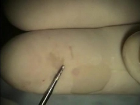 Dental Implant Microsurgery: Untreatable Root Resorption