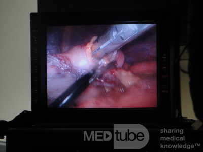 Gastric Ulcerated Adenocarcinoma of the Pre-pyloric Antrum (7 of 28)