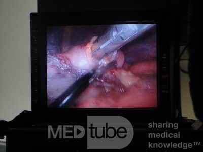 Gastric Ulcerated Adenocarcinoma of the Pre-pyloric Antrum (7 of 28)