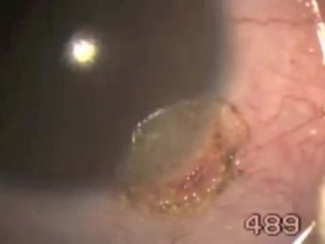 Limbal Dermoid Ablation - Fugo Blade