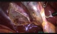 Minilaparoscopic Cholecystectomy - Half-Dome-Down Clipless Technique