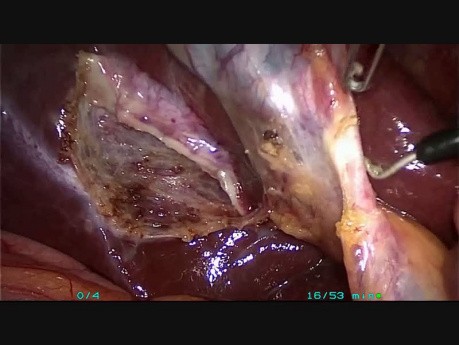 Minilaparoscopic Cholecystectomy - Half-Dome-Down Clipless Technique