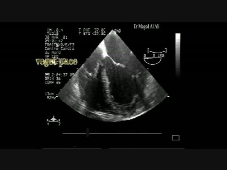 Infective Endocarditis: Vegetation On The Pacemaker Lead