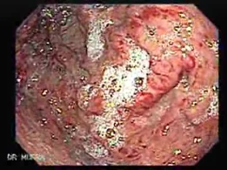 Gastric Varices Rosettes Formation (19 of 22)