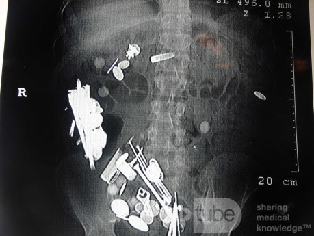 Multiple Foreign bodies in the GI tract (12 of 12)