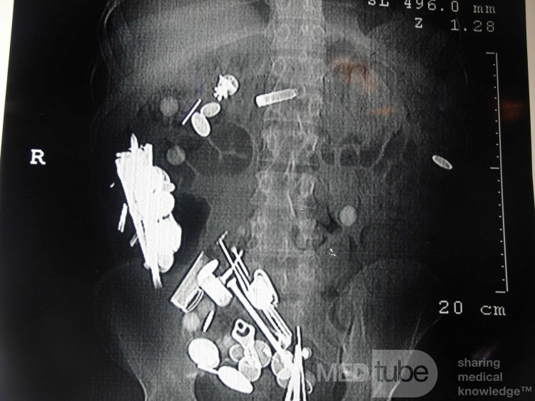 Multiple Foreign bodies in the GI tract (12 of 12)
