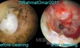 Otomycosis Before And After Ear Toilet