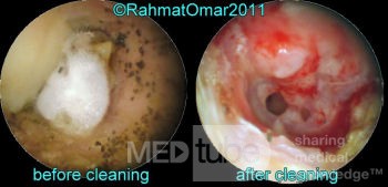 Otomycosis Before And After Ear Toilet