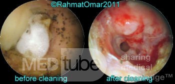 Otomycosis Before And After Ear Toilet