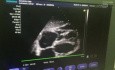Moderate Pericardial Effusion 
